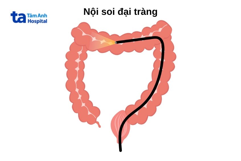 khoảng cách nội soi đại tràng