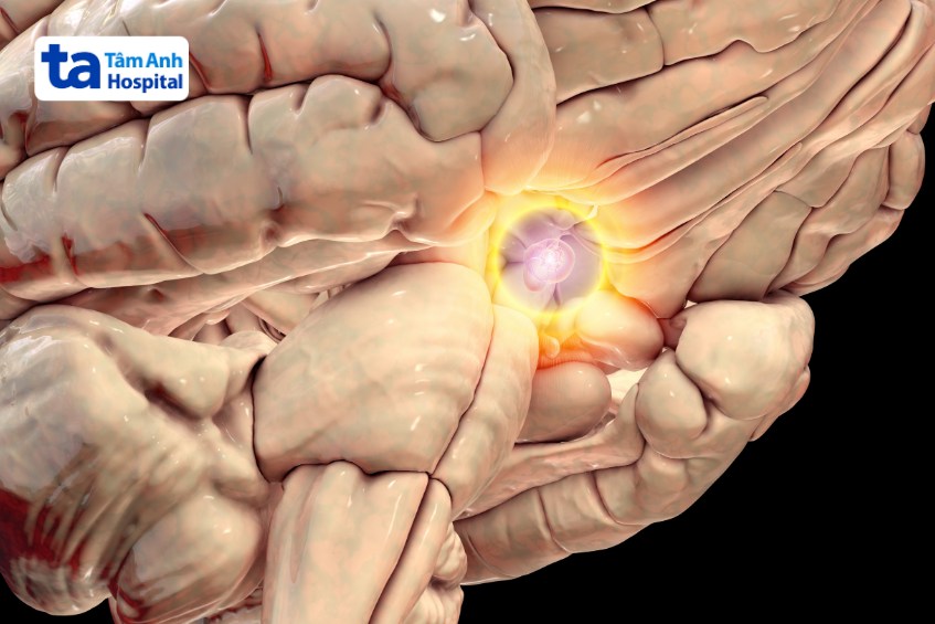 khối u cuộn tĩnh mạch lành tính hiếm gặp