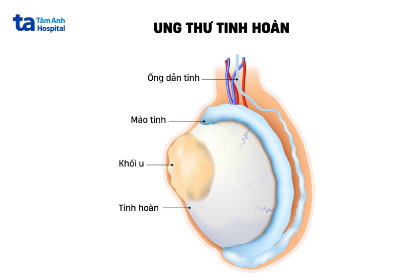 khối u ung thư tinh hoàn