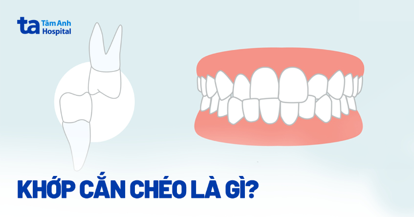 Khớp cắn chéo là gì? Nguyên nhân, cách nhận biết và điều trị
