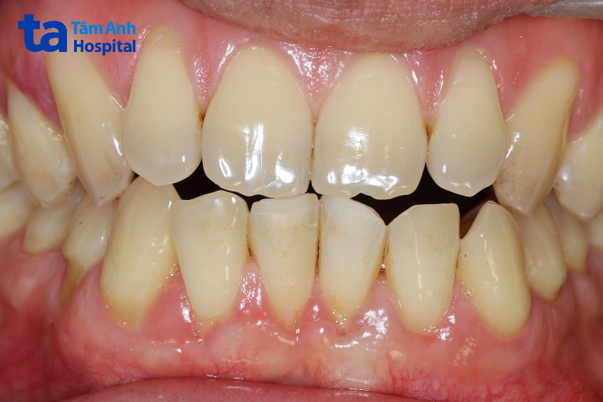 Dấu hiệu nhận biết khớp cắn đối đầu