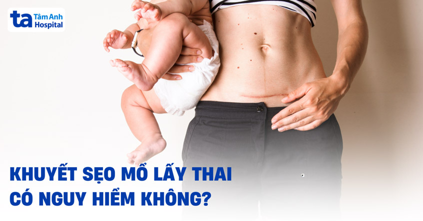 Khuyết sẹo mổ lấy thai có nguy hiểm không? Có biến chứng nào?