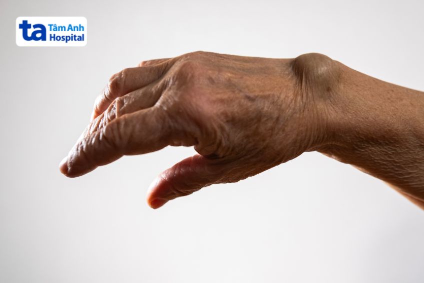 Kích thước của khối u bao hoạt dịch