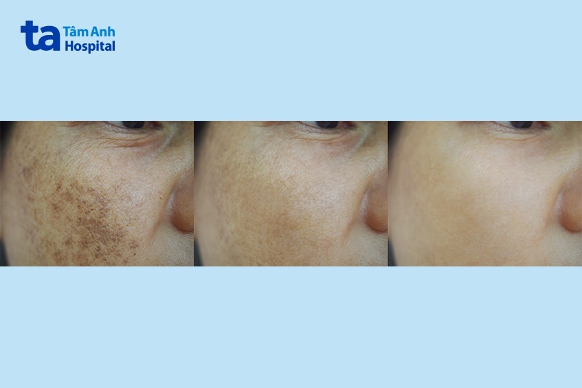 làn da trước và sau khi tiêm meso trị nám