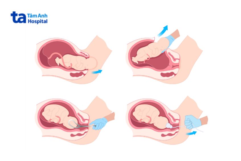 Minh họa các phương pháp sinh con