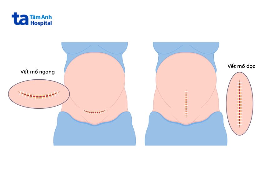 Mổ lấy thai có thể là vết mổ dọc hoặc mổ ngang đoạn dưới