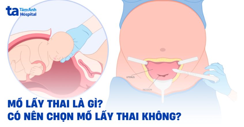 Mổ lấy thai là gì? Khi nào cần mổ và có nên chọn không?