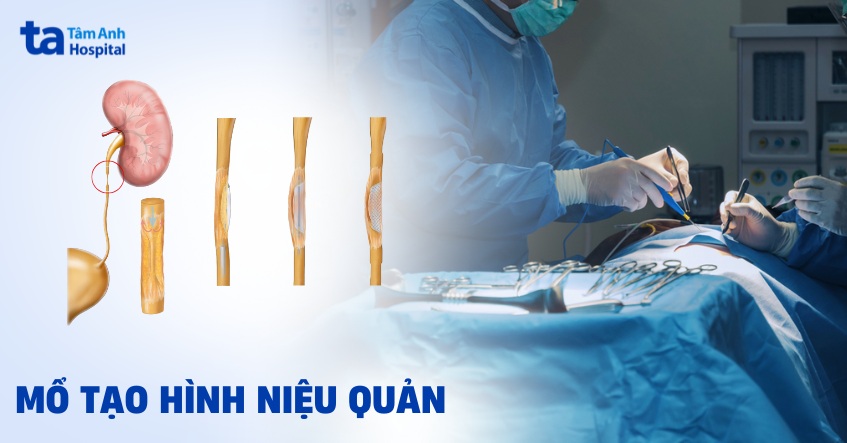 Mổ tạo hình niệu quản khi nào nên lựa chọn? Ưu và nhược điểm