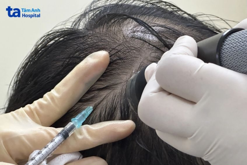 mỗi vị trí tiêm meso có tốc độ hấp thụ dưỡng chất khác nhau