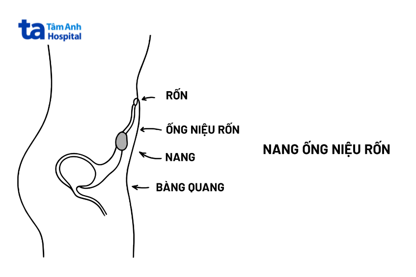 một hình thái thường gặp của tồn tại ống niệu rốn