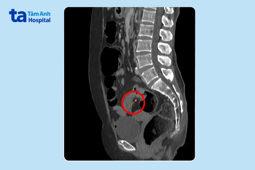 ảnh mri u trực tràng
