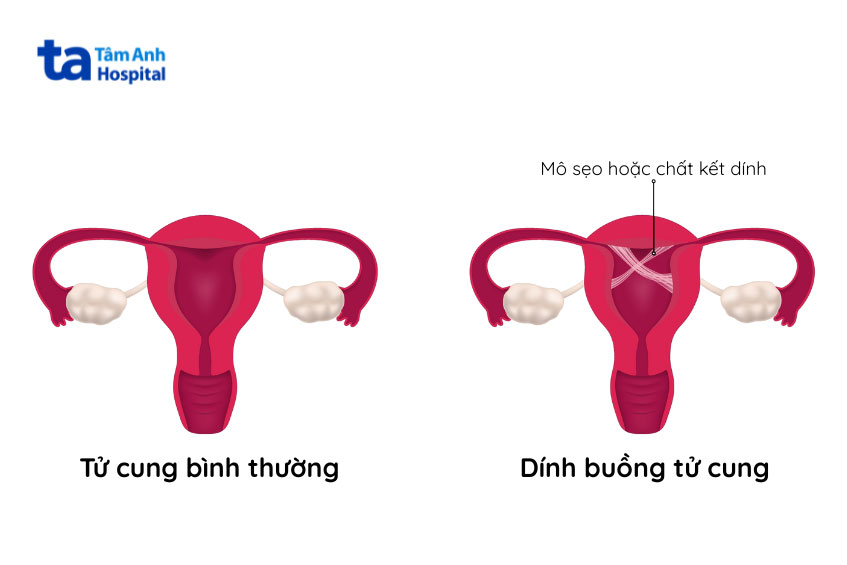 mức độ dính ảnh hưởng đến khả năng sinh sản