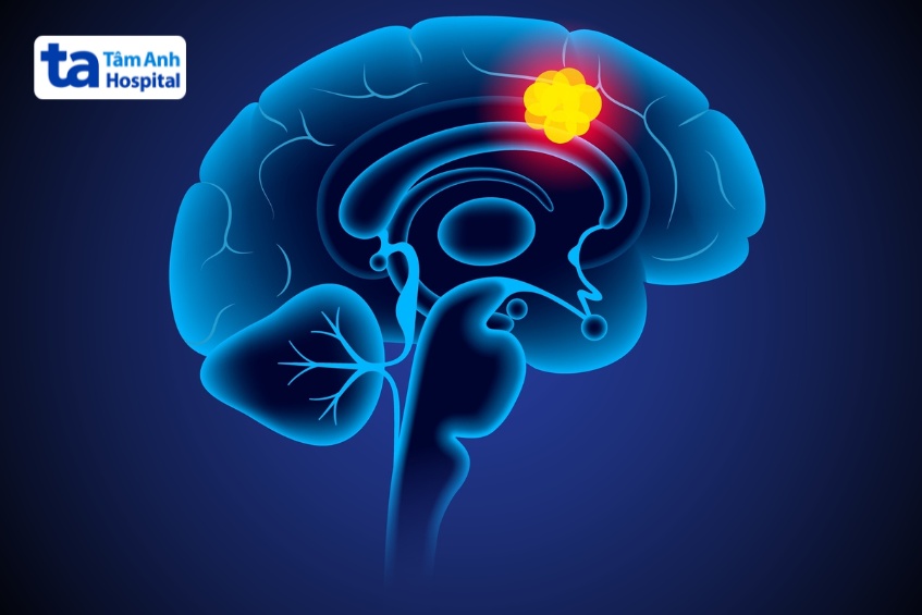mục tiêu của điều trị u não lành tính