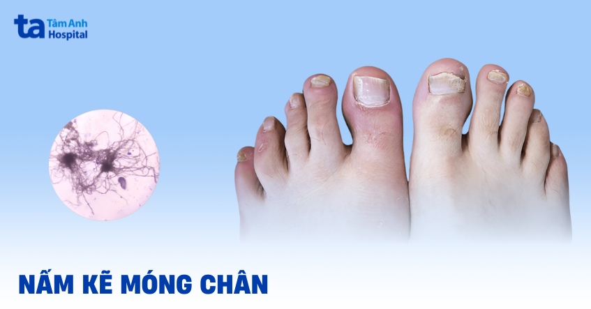 Nấm kẽ móng chân: Nguyên nhân, dấu hiệu, chữa trị, phòng ngừa