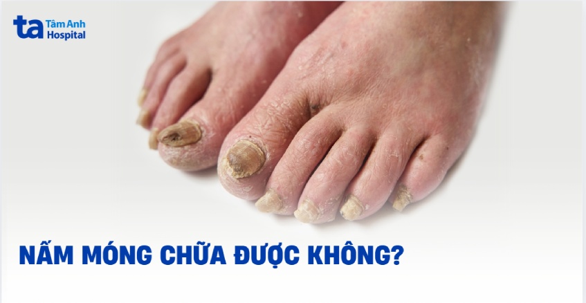 Nấm móng có chữa được không? Yếu tố nào ảnh hưởng kết quả?