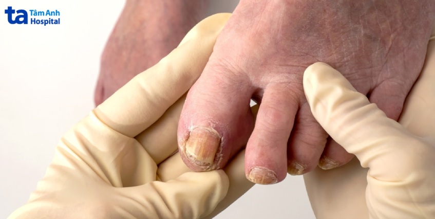 nấm móng thường trú ngụ ở bên dưới bề mặt móng