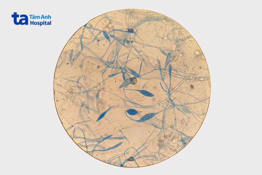 nấm ở kẽ móng chân chủ yếu do nấm dermatophytes gây ra