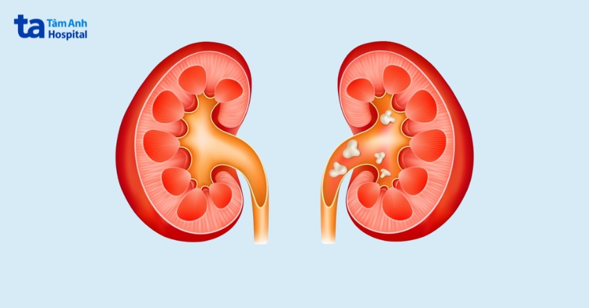 nguyên nhân chính gây thận ứ nước