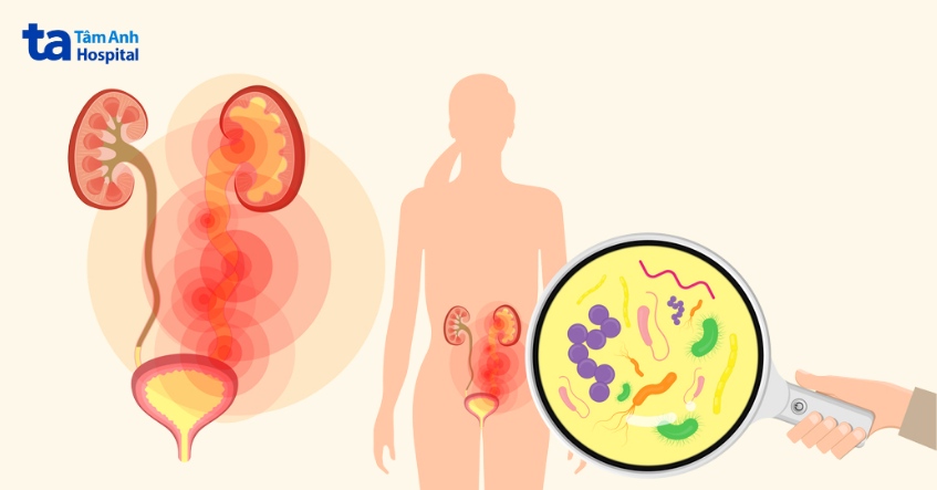 nguyên nhân gây sỏi niệu đạo nữ