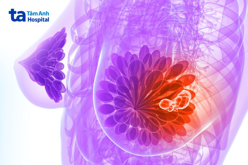 nguyên nhân gây ung thư biểu mô tuyến vú