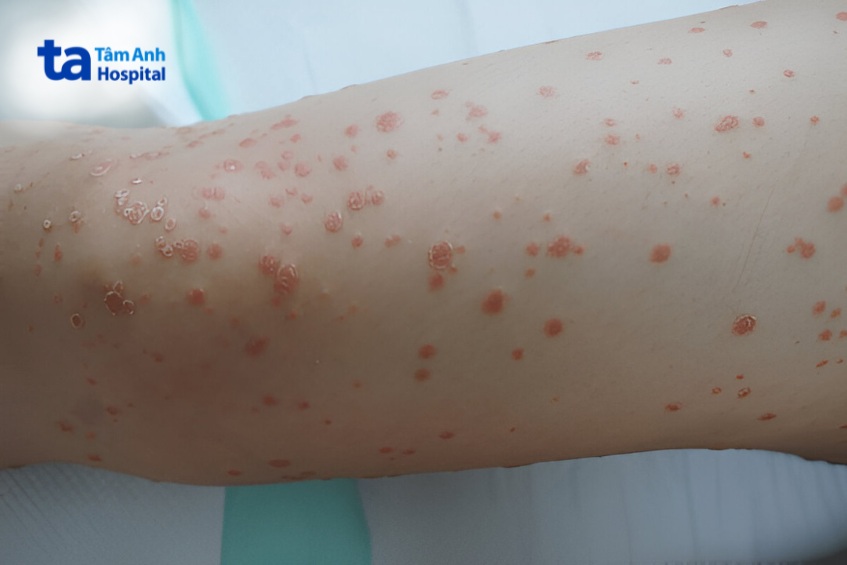 nguyên nhân vảy nến thể giọt gây ngứa