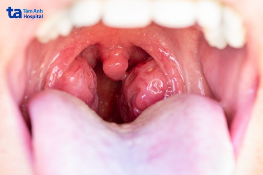 nguyên nhân viêm họng hạt mạn tính