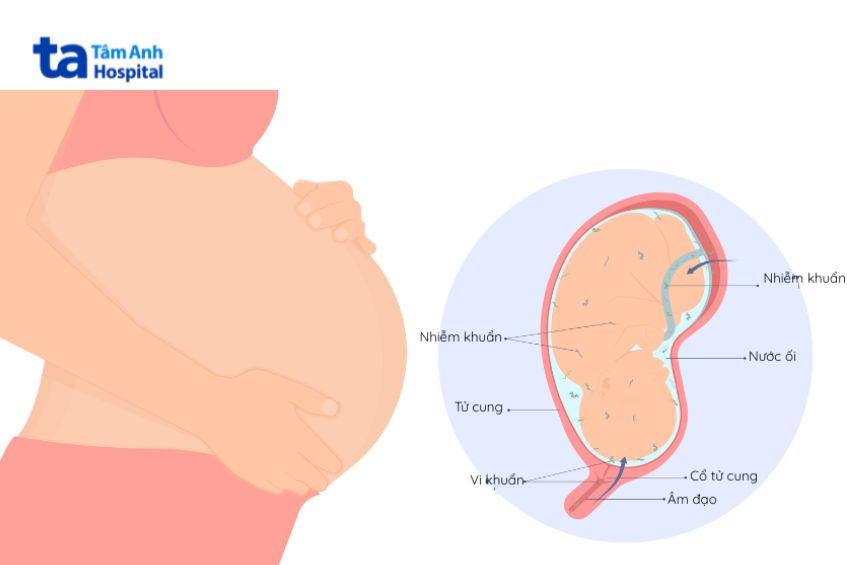 Nhiễm trùng ối khiến môi trường đảm bảo sự phát triển và sống còn của thai nhi không còn an toàn, gây nguy hiểm cho thai nhi