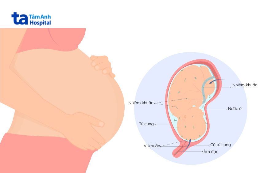 Nhiễm trùng ối phá vỡ môi trường nuôi dưỡng và hàng rào bảo vệ đảm bảo sự an toàn của thai nhi trong suốt thai kỳ