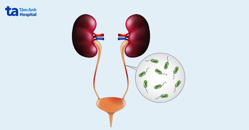 nhiễm trùng tiết niệu có thể gây đau trong quá trình tán sỏi