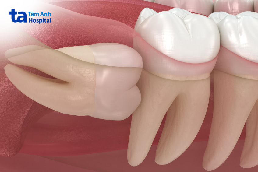 nhổ răng khôn bị sưng mặt mấy ngày