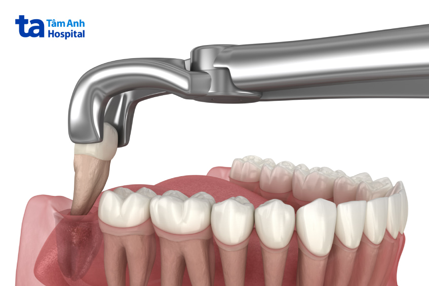 nhổ răng khôn sưng mặt bao lâu