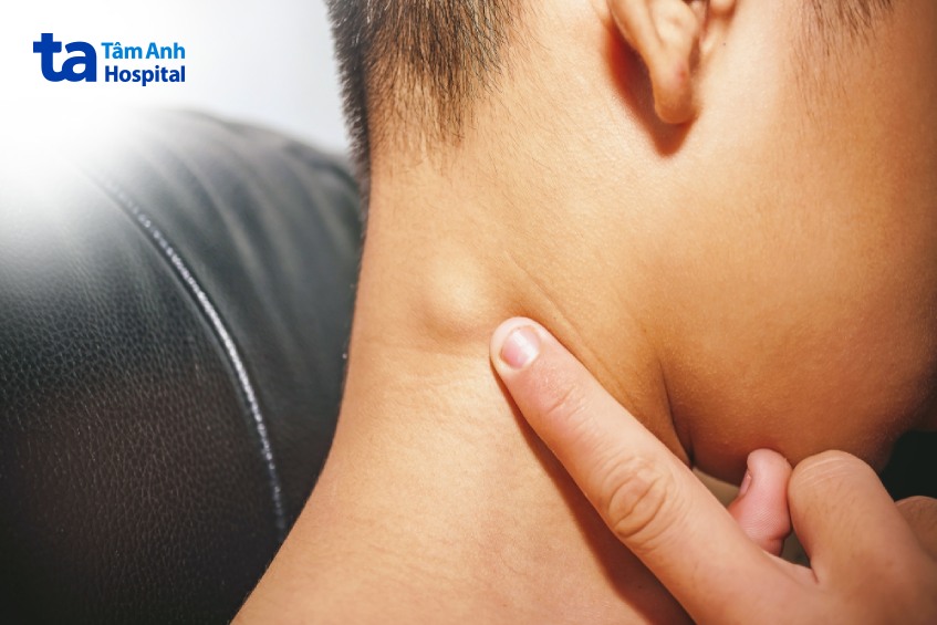 nổi hạch lành tính ở cổ