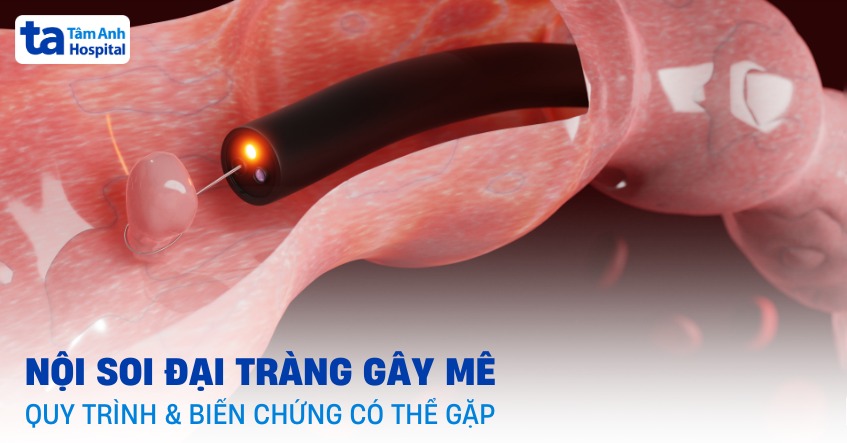 Nội soi đại tràng gây mê: Quy trình, biến chứng có thể gặp