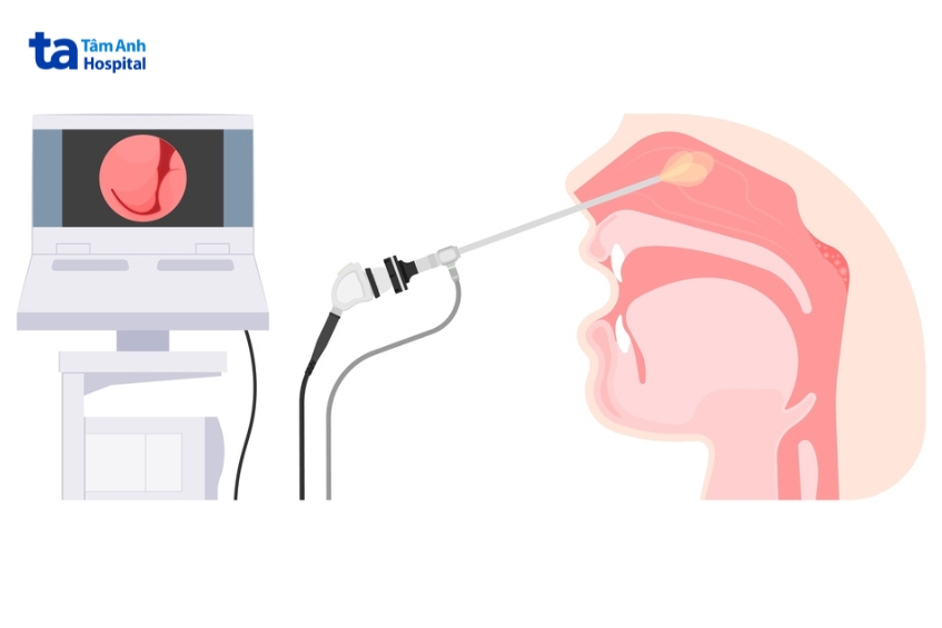 nội soi kiểm tra bệnh lý vòm họng