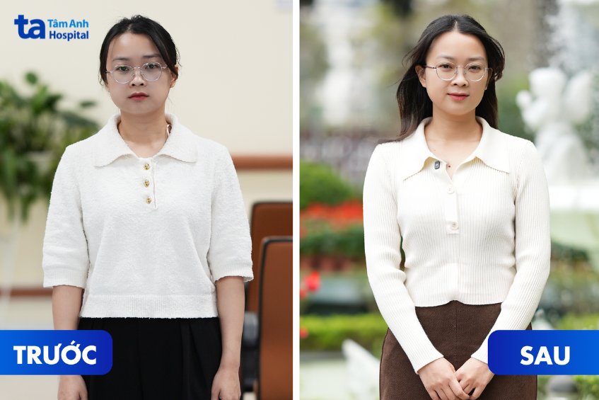 nữ khách hàng giảm mỡ bụng tại tâm anh