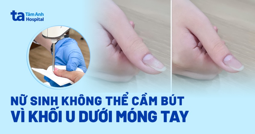 nữ sinh không thể cầm bút vì khối u dưới móng tay