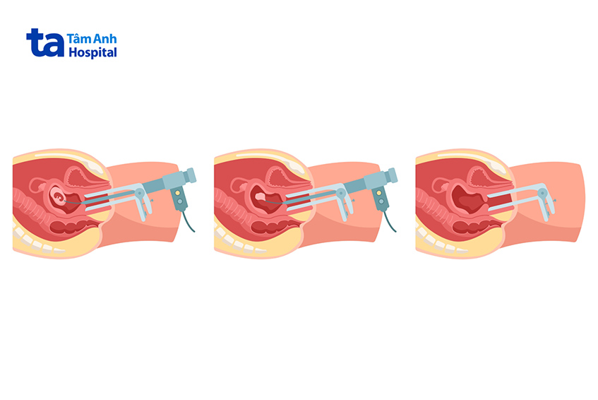 phá thai bằng hút chân không