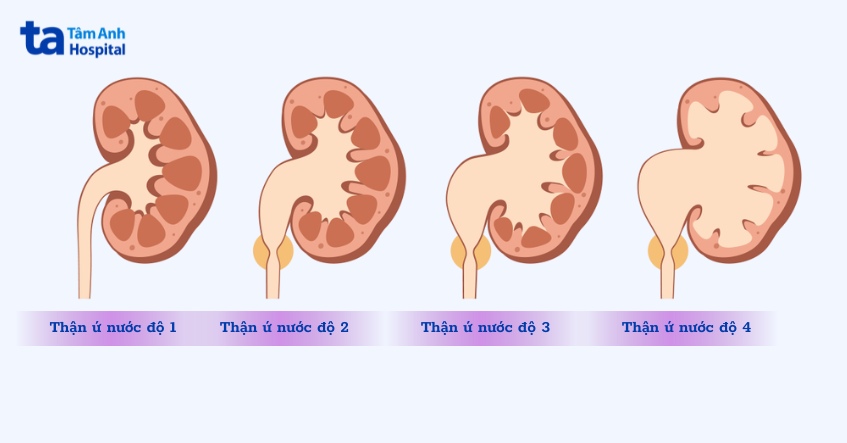 phân biệt thận ứ mủ và ứ nước