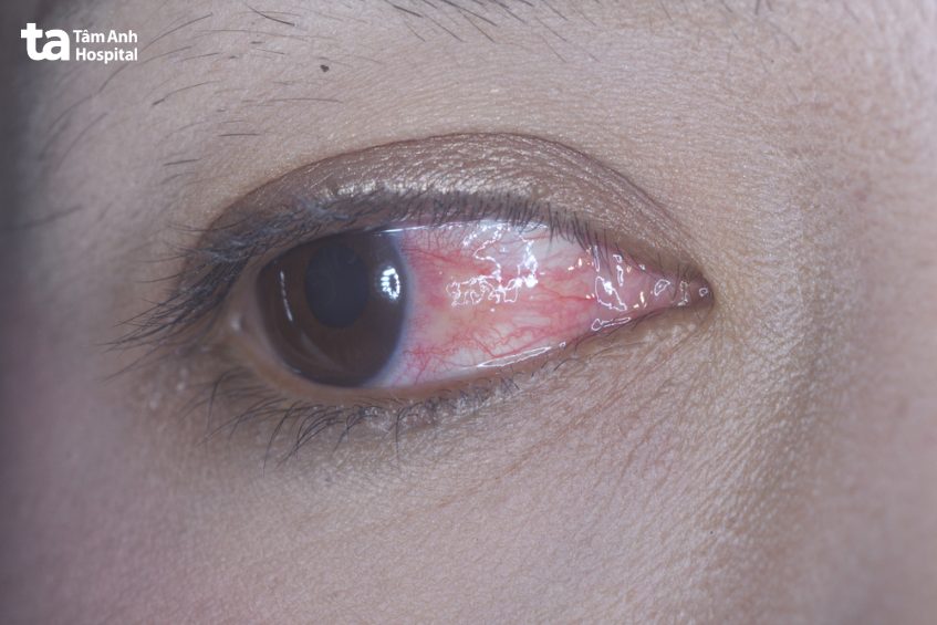 phân biệt viêm thượng củng mạc