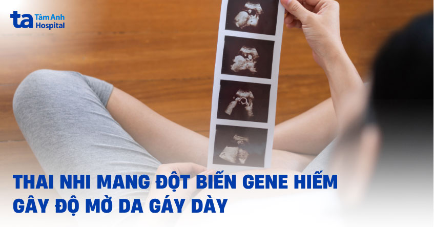 phát hiện thai nhi có đột biến gen bằng đo da gáy