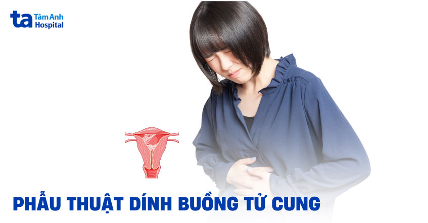 Phẫu thuật dính buồng tử cung có hiệu quả không? Khi nào nên mổ?