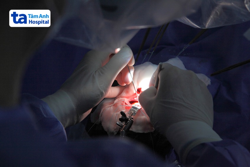 phẫu thuật loại bỏ khối u màng não cpa