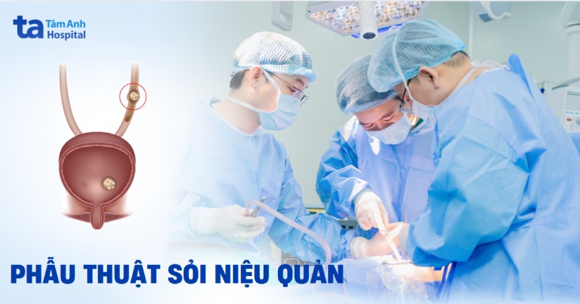 Phẫu thuật sỏi niệu quản chỉ định khi nào? Ưu nhược điểm và lưu ý cần biết