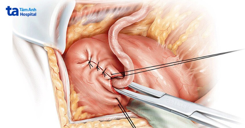phẫu thuật tái ghép lại niệu quản vào bàng quang
