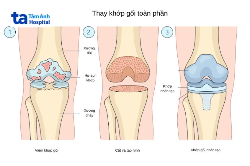 Phẫu thuật thay khớp gối