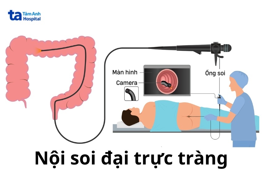 phương pháp nội soi đại trực tràng