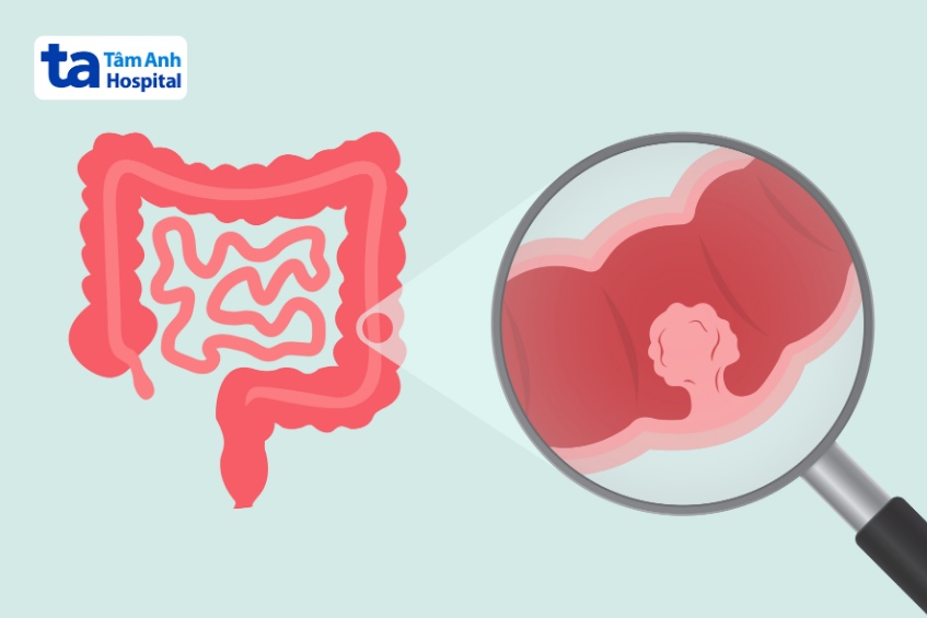 quy trình nội soi đại tràng gây mê