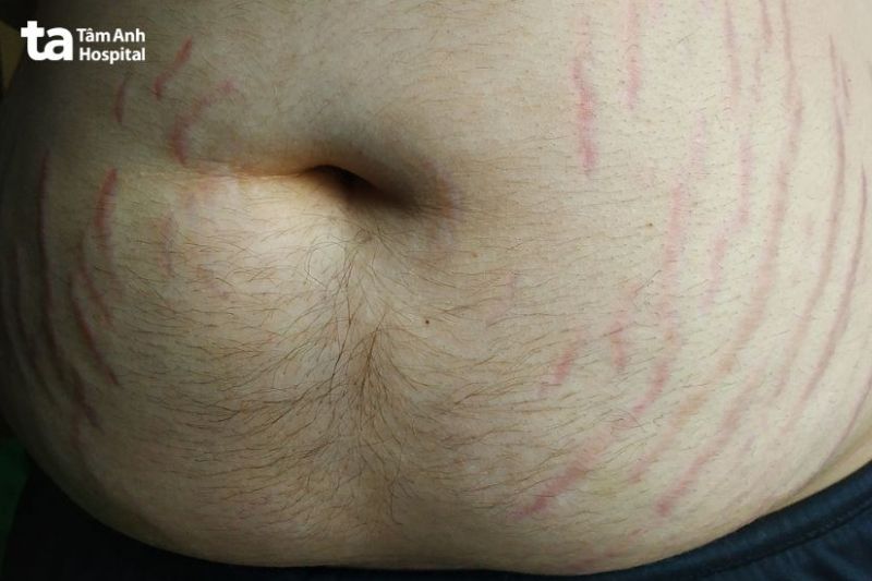 bụng bị rạn da đỏ