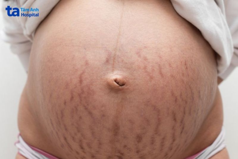 phụ nữ mang thai dễ bị rạn da