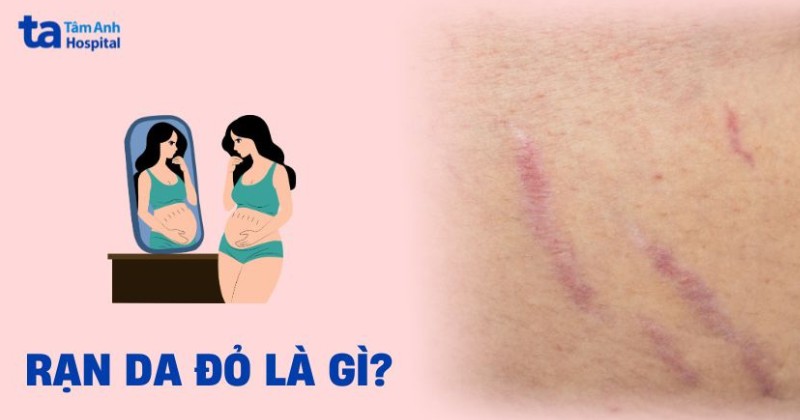 Rạn da đỏ là gì? Nguyên nhân, hình ảnh và cách điều trị